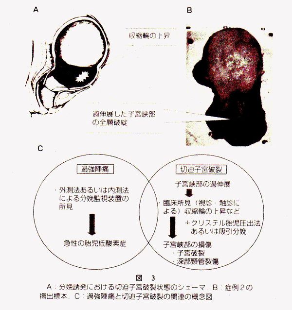 産科医療のこれから: 予定日超過妊娠の取扱いと、分娩誘発についてo(^-^)o..｡*♡