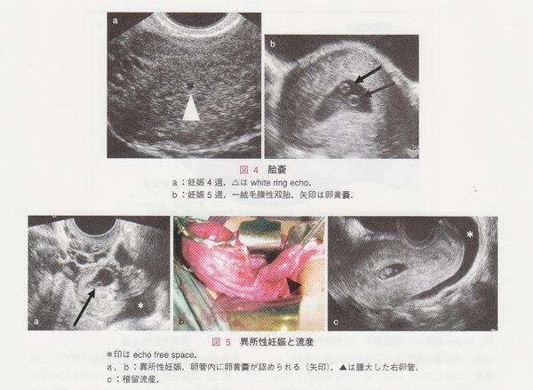 産科医療のこれから 産婦人科救急疾患 子宮外妊娠は大変気をつけるべき病気です